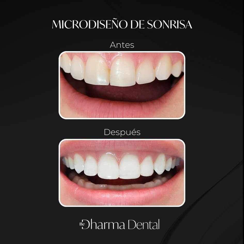 Antes y después de Microdiseño de Sonrisa en Medellín - Be Dharma Dental - Odontología Estética Medellín - Colombia