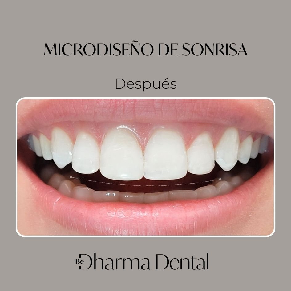 Antes y después de Microdiseño de Sonrisa en Medellín - Be Dharma Dental - Odontología Estética en Medellín