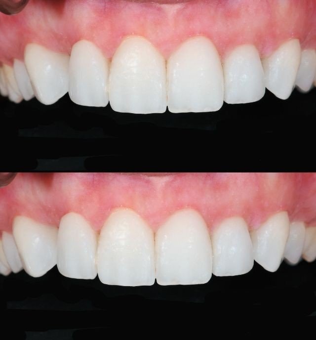 Diseño de sonrisa Medellín - Be Dharma Dental - Torre Médica Oviedo