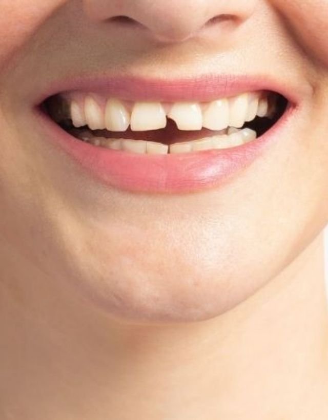 Oburación dental con Resina - Odontología estética en Medellín - Be Dharma Dental