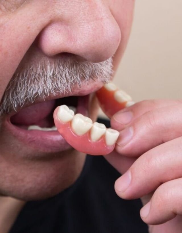 Prótesis dentales en Medellín - Be Dharma Dental - Odontología estética en Medellín