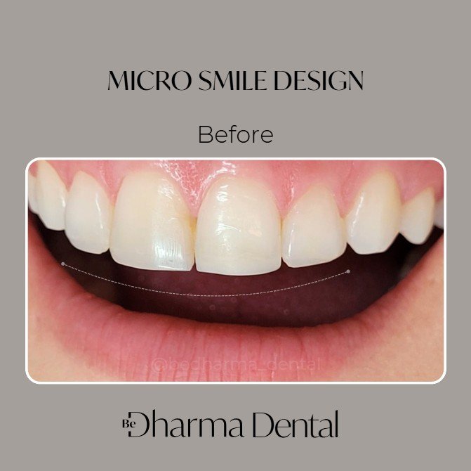 Micro Smile Design in Medellín-Be Dharma Dental 1