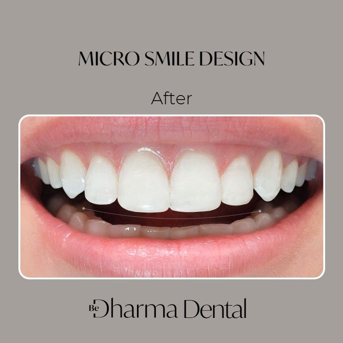 Micro Smile Design in Medellín-Be Dharma Dental 2