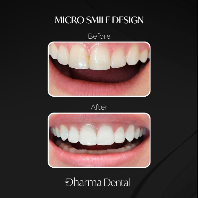 Micro Smile Design in Medellín-Be Dharma Dental 3