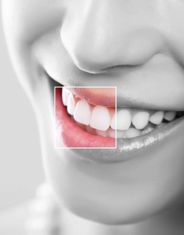 Mini smile makeover at Be Dharma Dental in Medellín