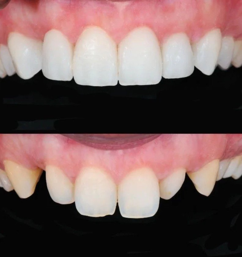 Smile design in Colombia before and after - Be Dharma Dental - Dentistry clinic in Medellín