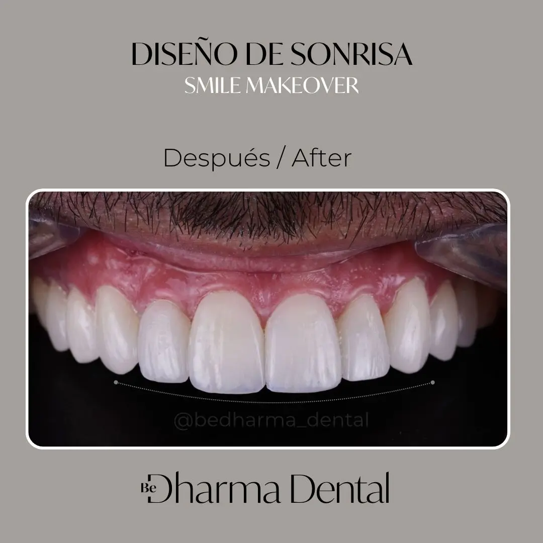 Antes y después de diseño de Sonrisa en Medellín - Be Dharma Dental - Odontología Estética en Medellín 2