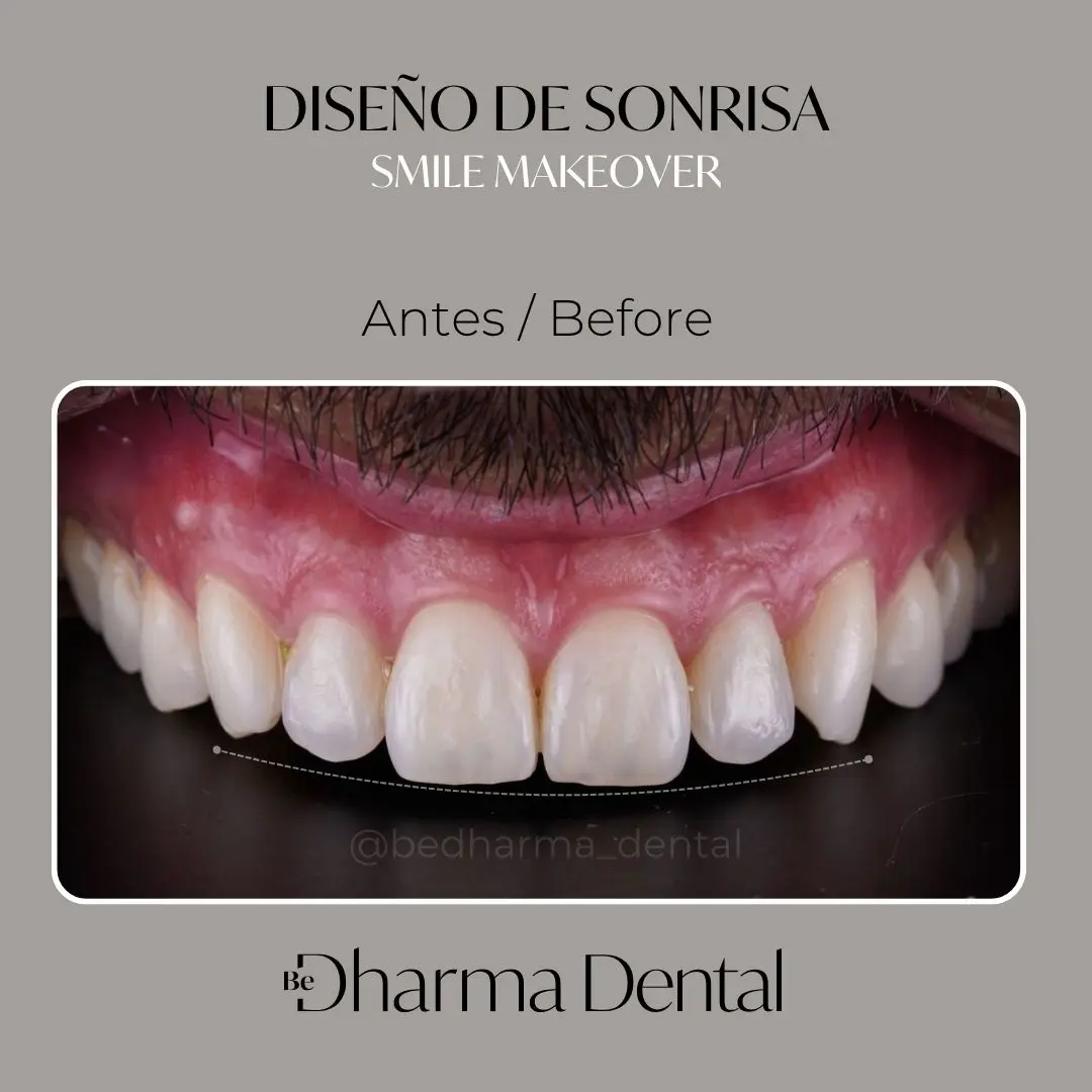 Antes y después de diseño de Sonrisa en Medellín - Be Dharma Dental - Odontología Estética en Medellín