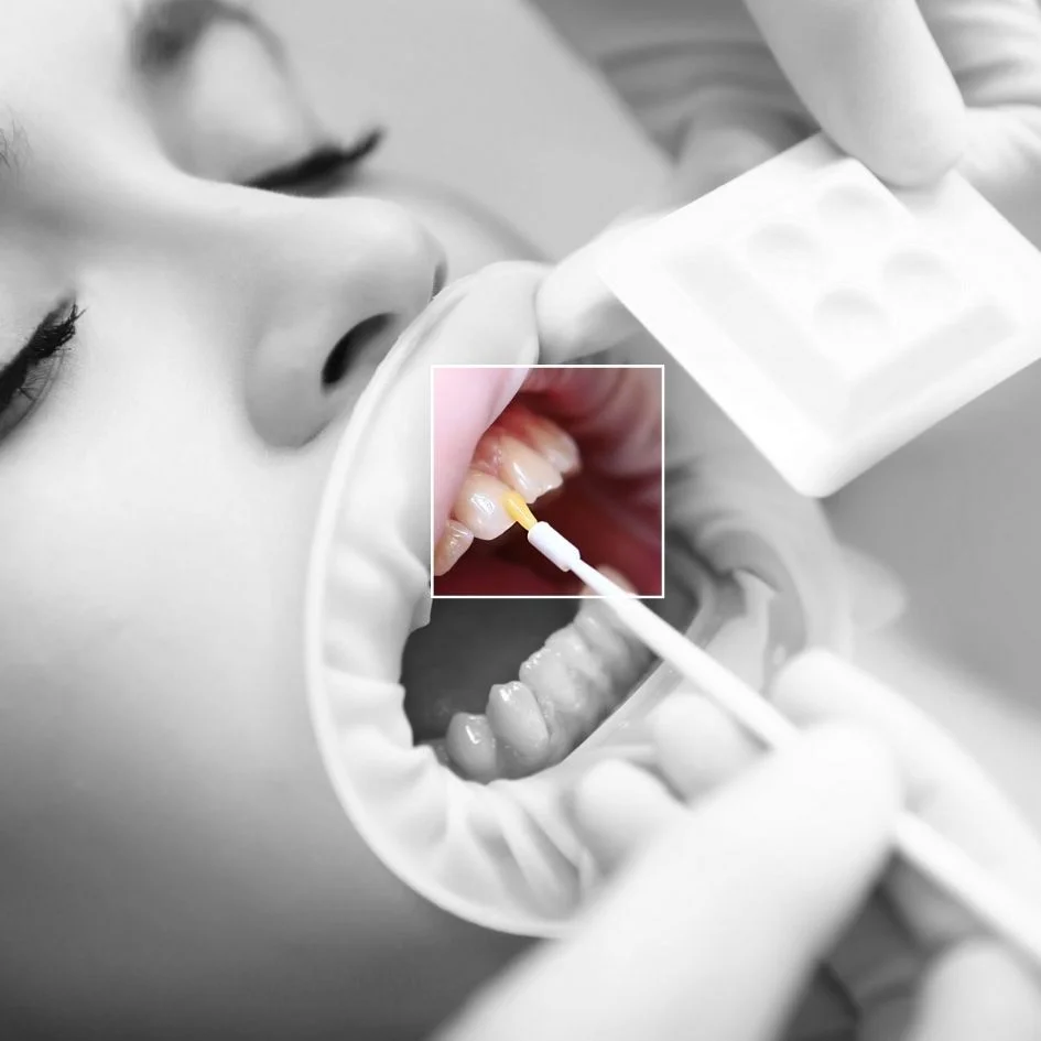 Aplicacion-de-Fluor-Dental-en-Medellin-Odontologia-estetica-en-Medellin-Be-Dharma-Dental