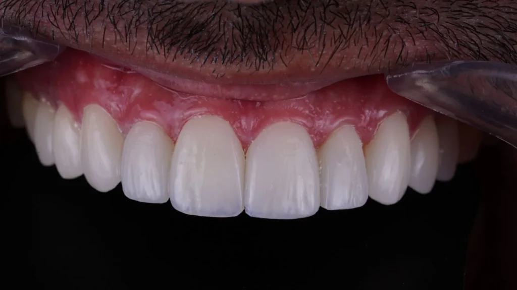 BE DHARMA DENTAL - DISEÑO DE SONRISA