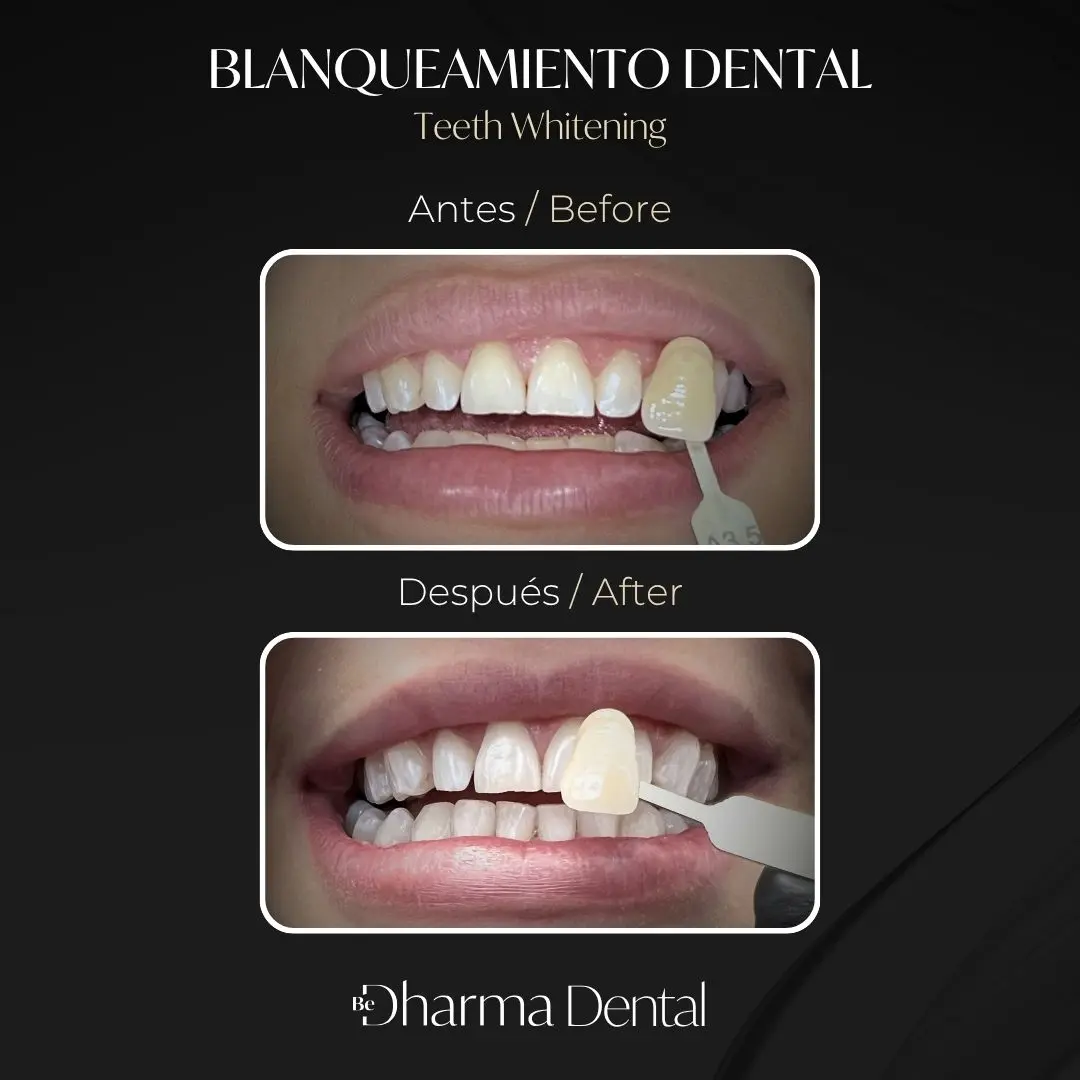 Blanqueamiento dental antes y después en la clínica odontológica Be Dharma Dental - Medellín, Colombia- 060426