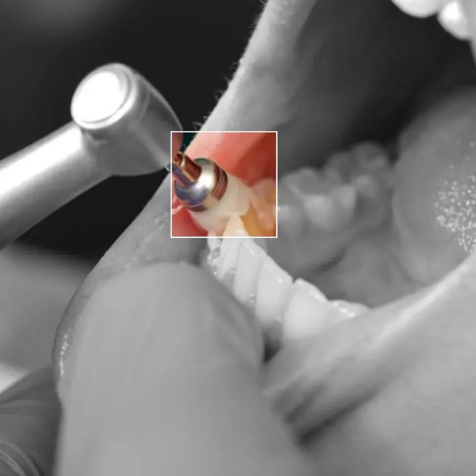 ¿Cómo se hace una limpieza dental profunda?-Dharma Dental