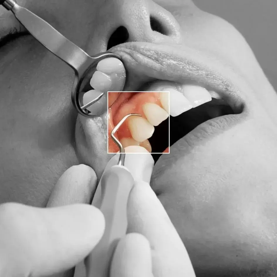 ¿Cómo se hace una limpieza dental profunda?-Dharma Dental