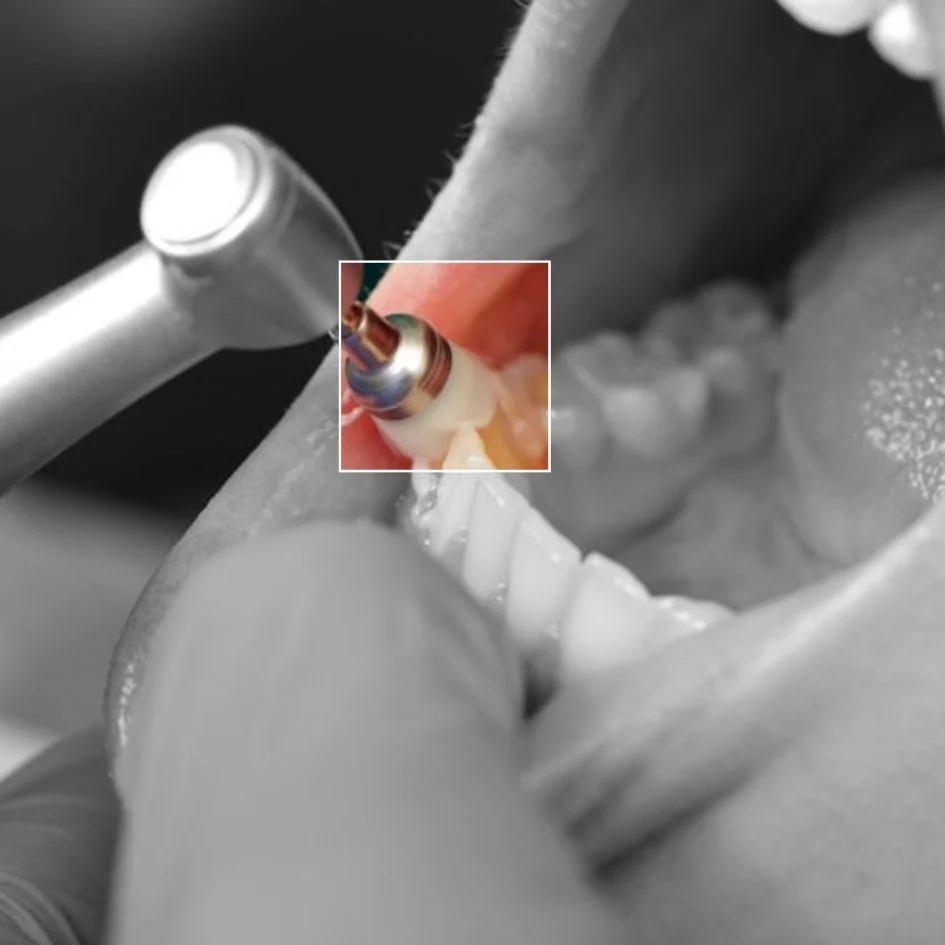 Detartraje-dental-con-Ultrasonido-en-Medellin-Odontologia-estetica-en-Medellin-Be-Dharma-Dental