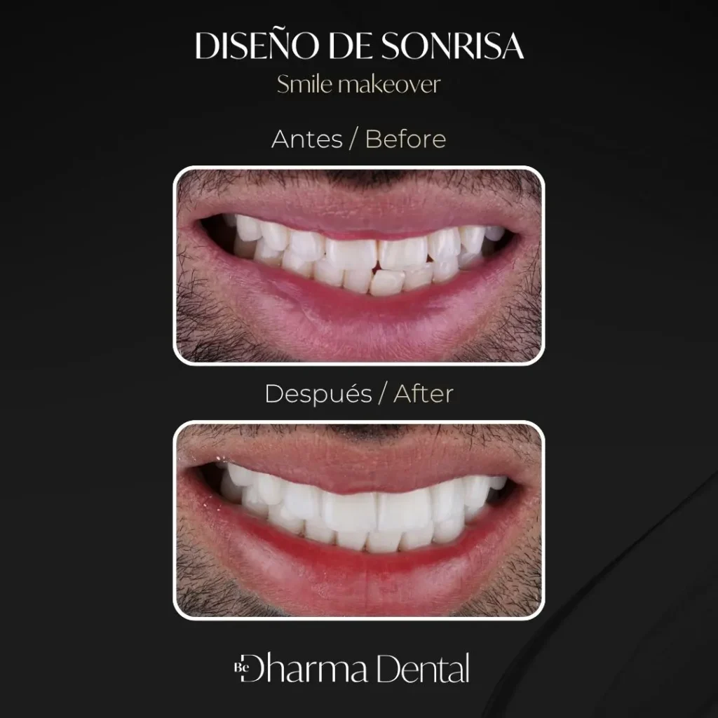 Diseño de sonrisa antes y después en la clínica odontológica Be Dharma Dental - Medellín, Colombia- 060426