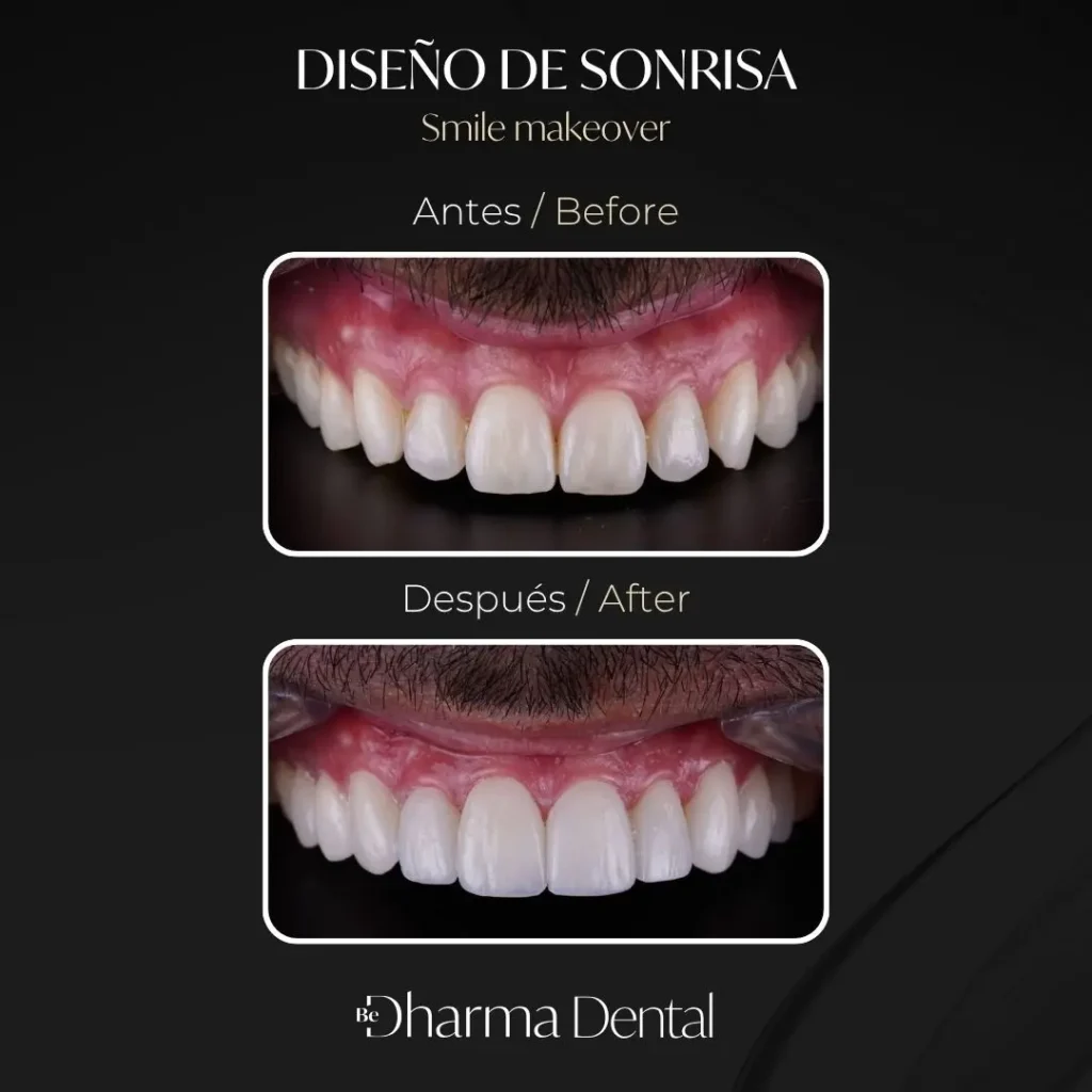 Diseño de sonrisa antes y después en la clínica odontológica Be Dharma Dental - Medellín, Colombia- 060426 2