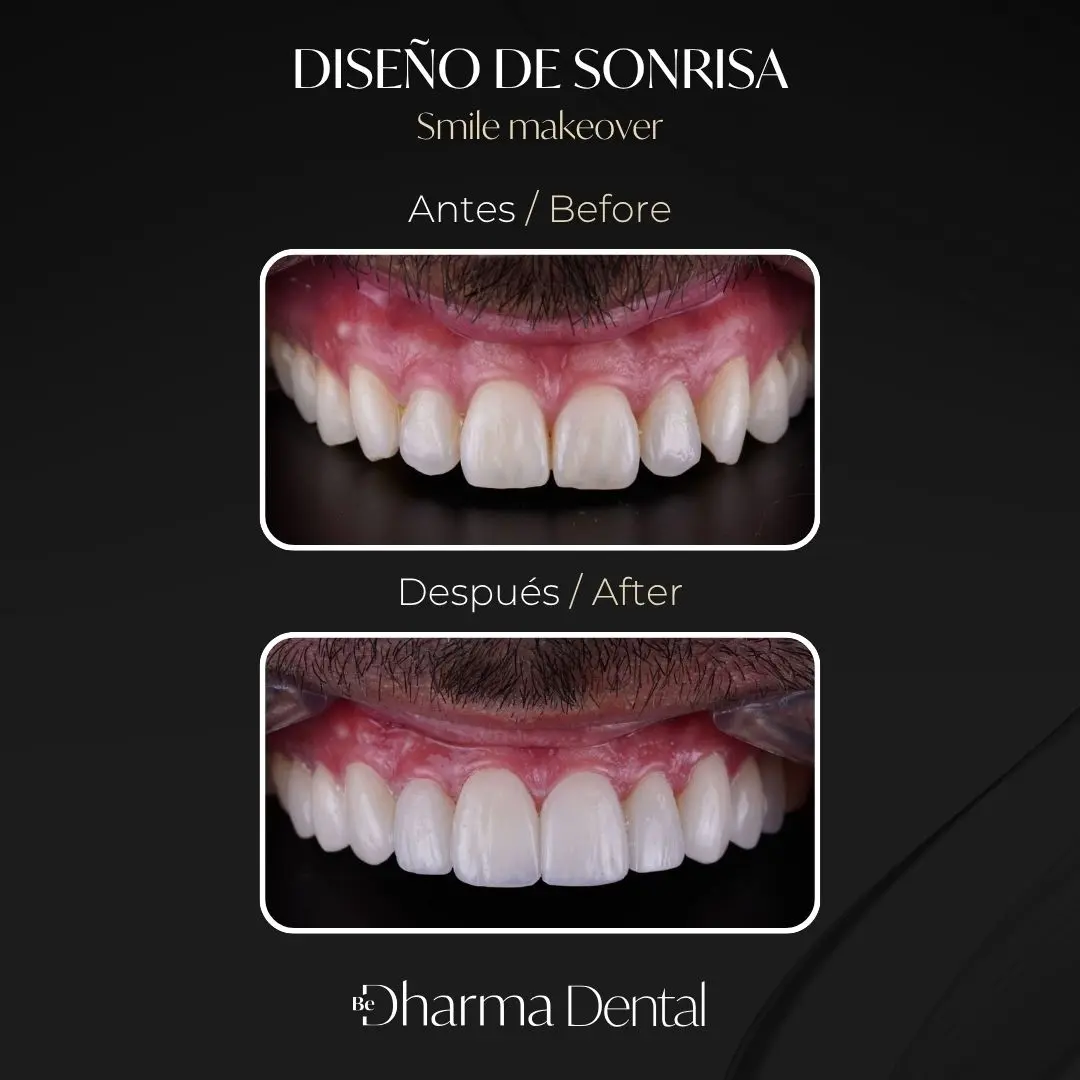 Diseño de sonrisa antes y después en la clínica odontológica Be Dharma Dental - Medellín, Colombia- 060426 2