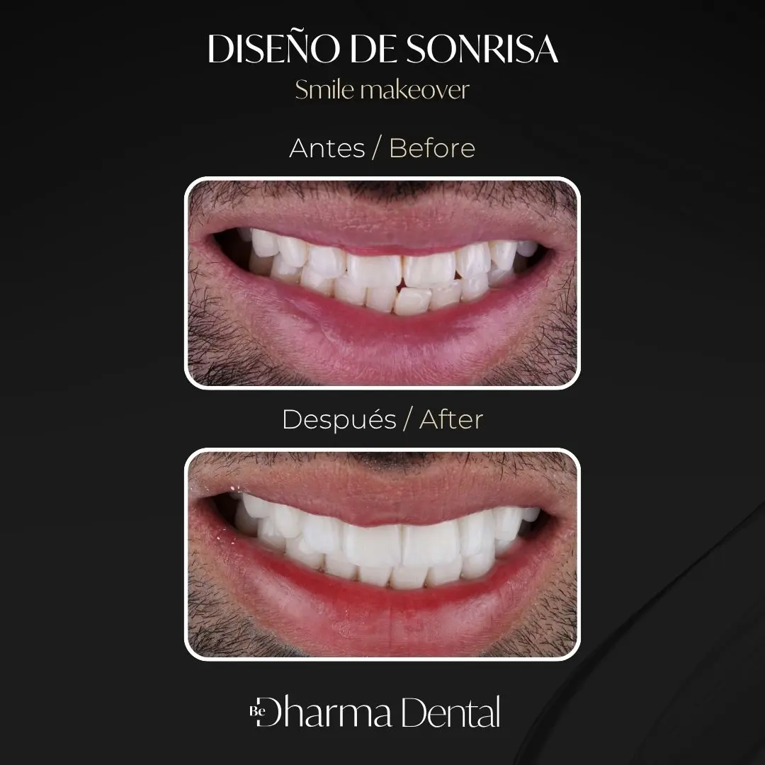 Diseño de sonrisa antes y después en la clínica odontológica Be Dharma Dental - Medellín, Colombia- 060426