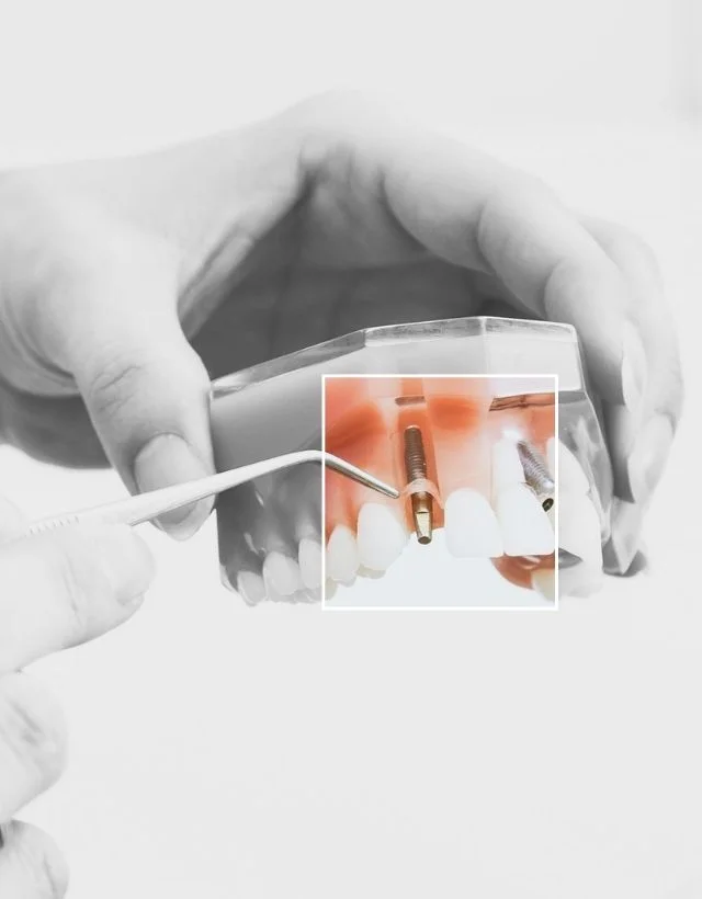 Implantes-Dentales-en-Medellin-Be-Dharma-Dental