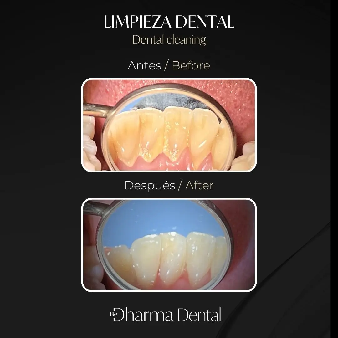 Limpieza dental antes y después en la clínica odontológica Be Dharma Dental - Medellín, Colombia- 060426