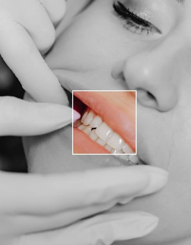 Mantenimiento-de-Diseno-de-sonrisa-en-Medellin-Centro-Estetico-Be-Dharma-en-Medellin-Be-Dharma-Dental-Colombia-Odontologia-Estetica-en-Medellin