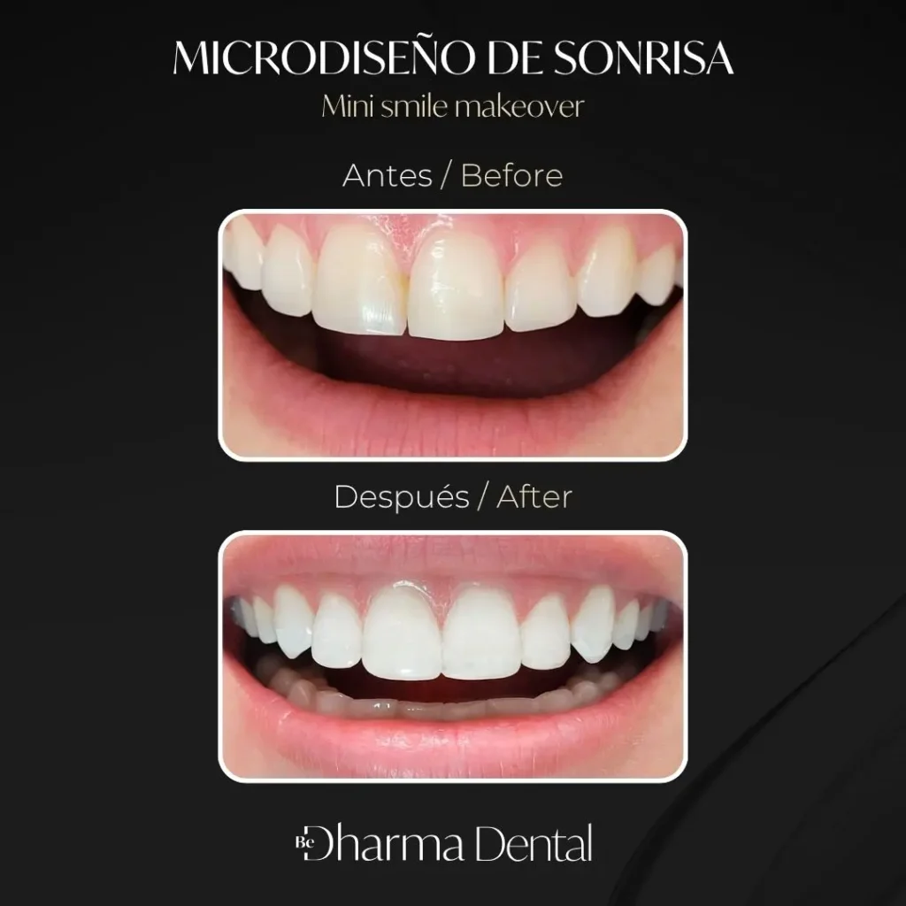 Microdiseño de sonrisa antes y después en la clínica odontológica Be Dharma Dental - Medellín, Colombia- 060426