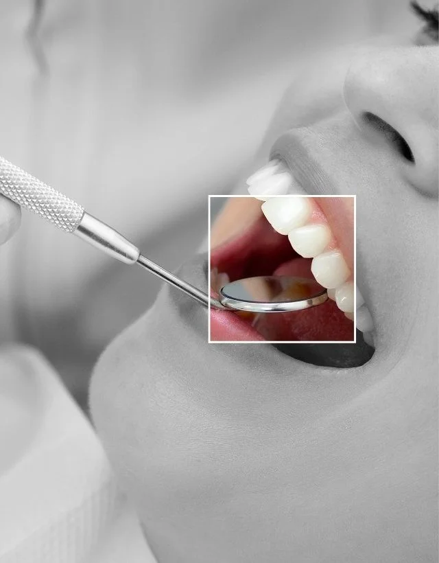 Obturacion-dental-con-resina-en-Medellin-Centro-Estetico-Be-Dharma-en-Medellin-Be-Dharma-Dental-Colombia-Odontologia-Estetica-en-Medellin