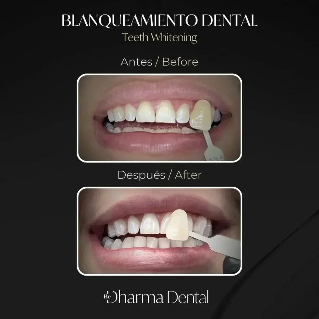 Professional Teeth Whitening in Medellín- Be Dharma Dental