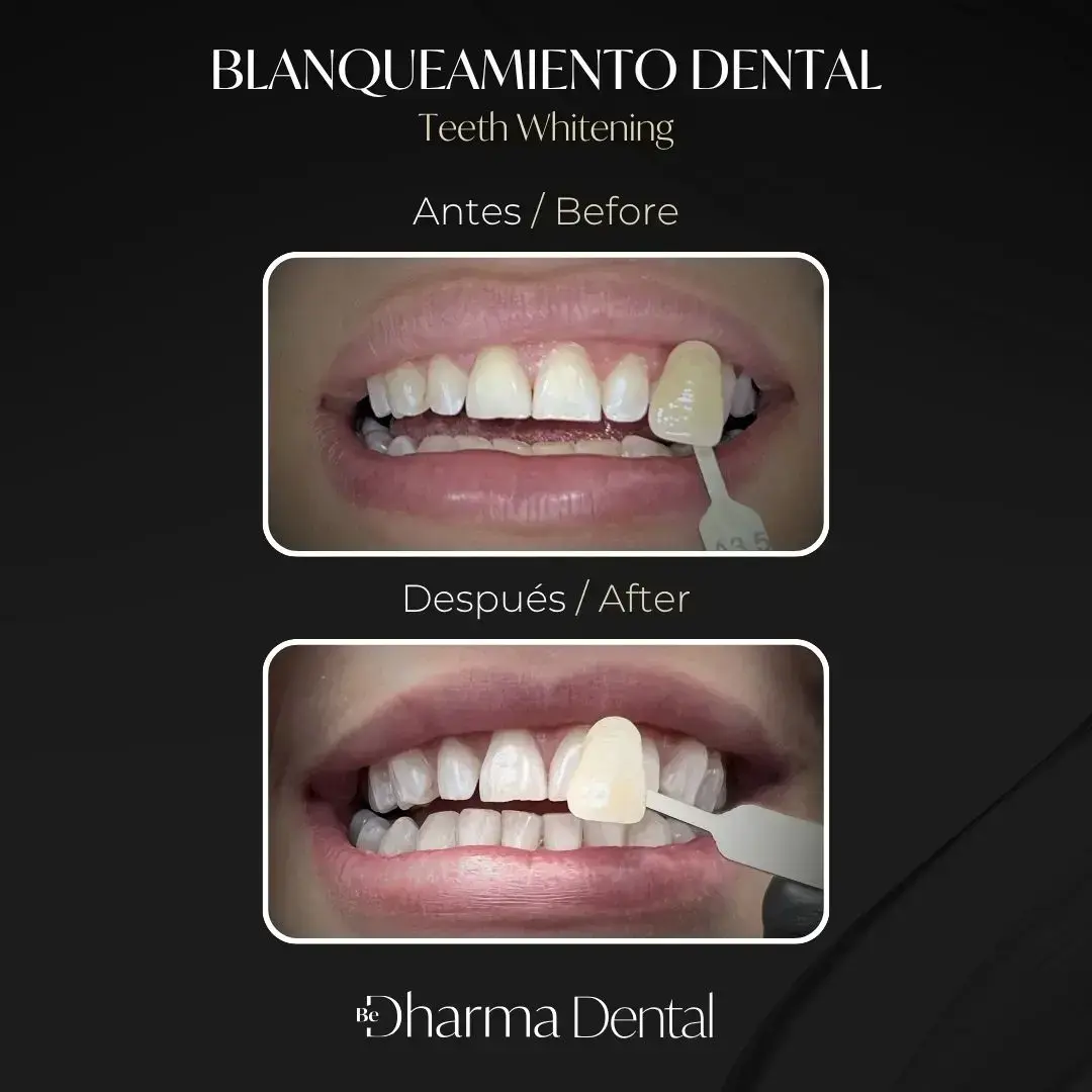 Teeth whitening before and after (shade C3 to A1), real bilingual case at Be Dharma Dental Medell&iacute;n
