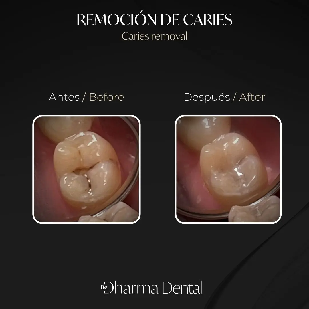 Remoción de caries antes y después en la clínica odontológica Be Dharma Dental - Medellín, Colombia- 060426