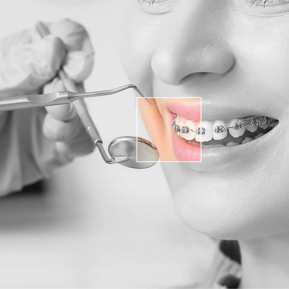 Retiro-de-ortodoncia-en-Medellin-retiro-de-braquets-Odontologia-estetica-en-Medellin