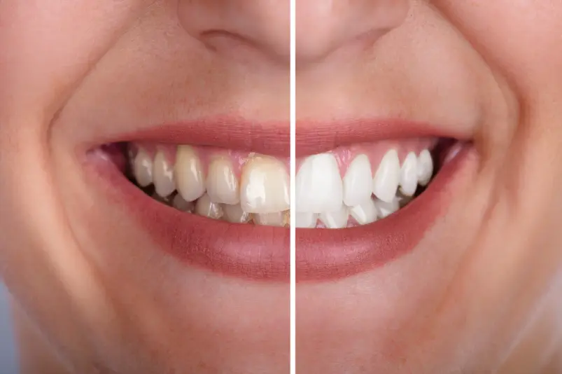 Teeth Whitening in Medellín-Dharma Dental
