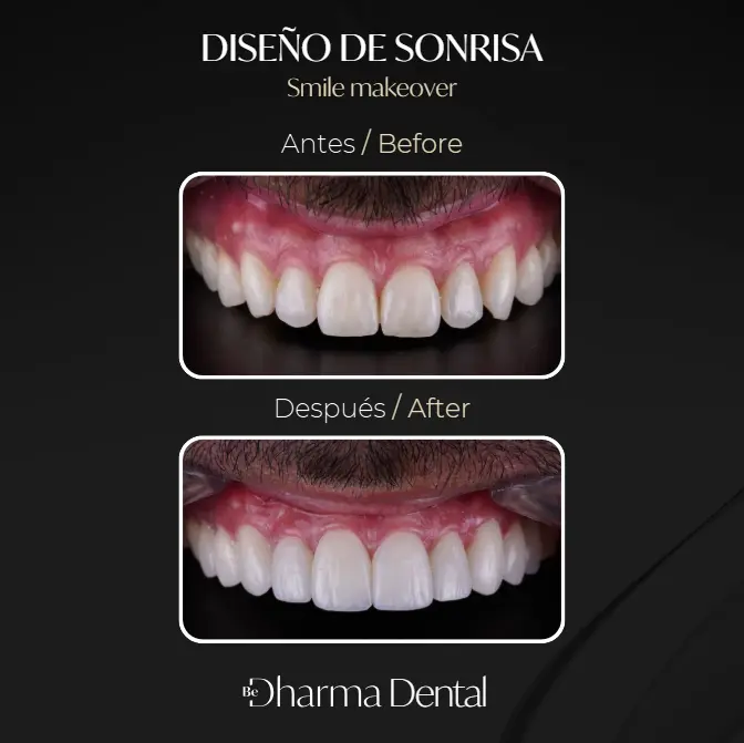 Diseño de Sonrisa antes y después-Be Dharma Dental Medellín