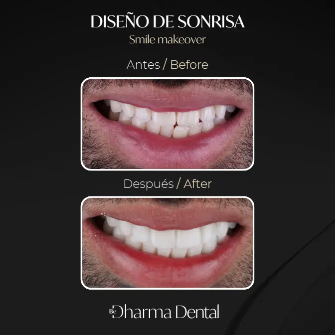 Diseño de Sonrisa antes y después-Be Dharma Dental Torre Médica de Oviedo