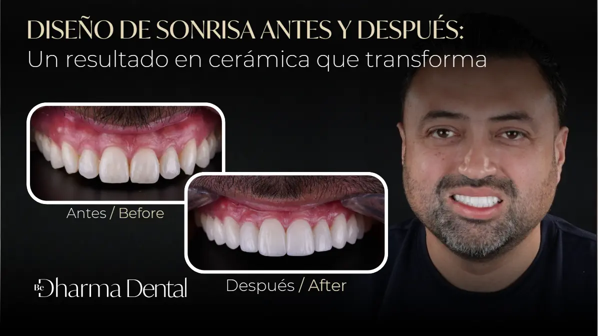 Diseño de Sonrisa antes y después-Be Dharma Dental