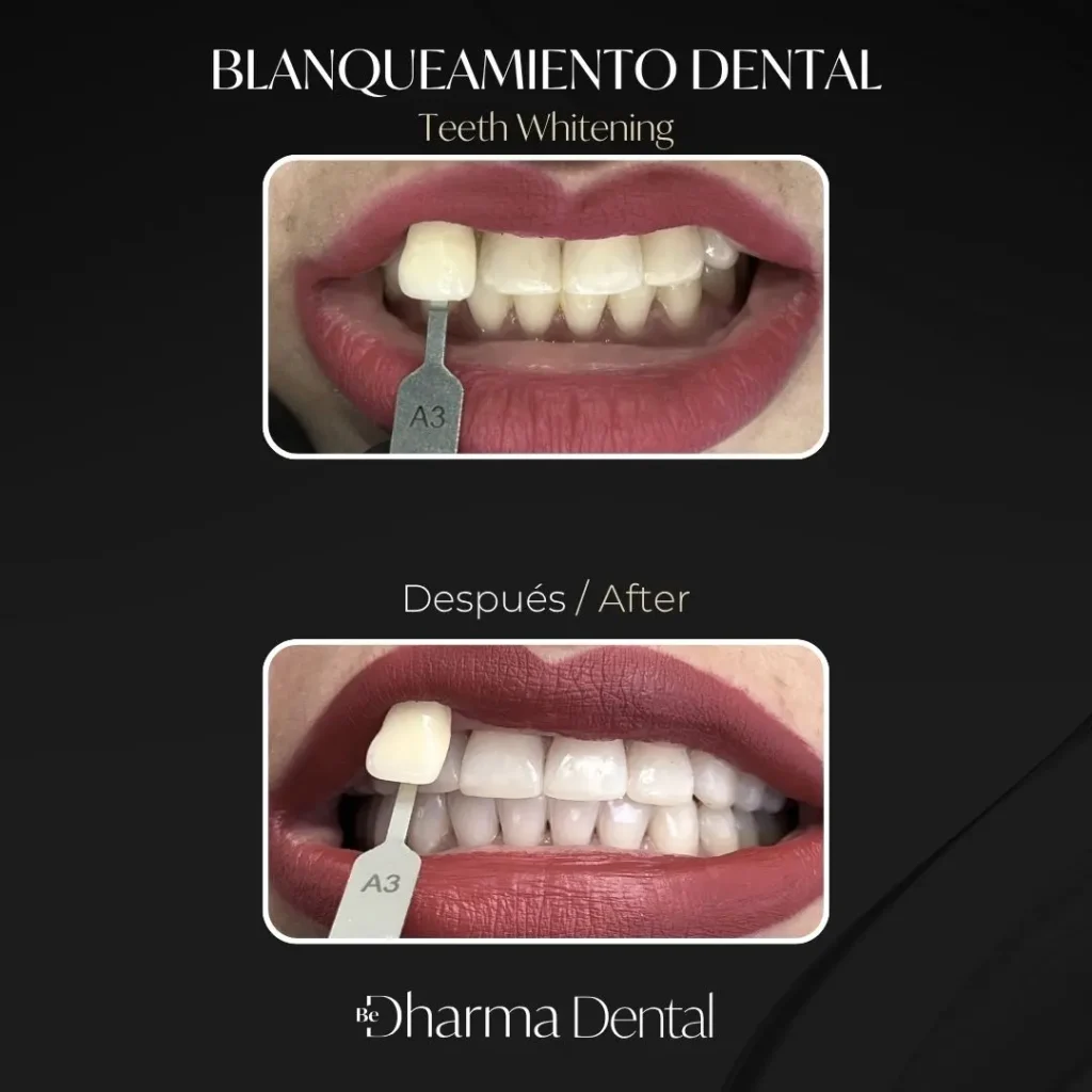Blanqueamiento dental antes y después en la clínica odontológica Be Dharma Dental - Medellín, Colombia- 050626