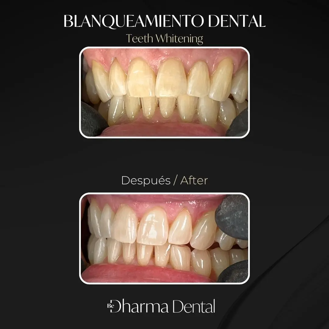 Blanqueamiento dental antes y después en la clínica odontológica Be Dharma Dental - Medellín, Colombia- 060426 2