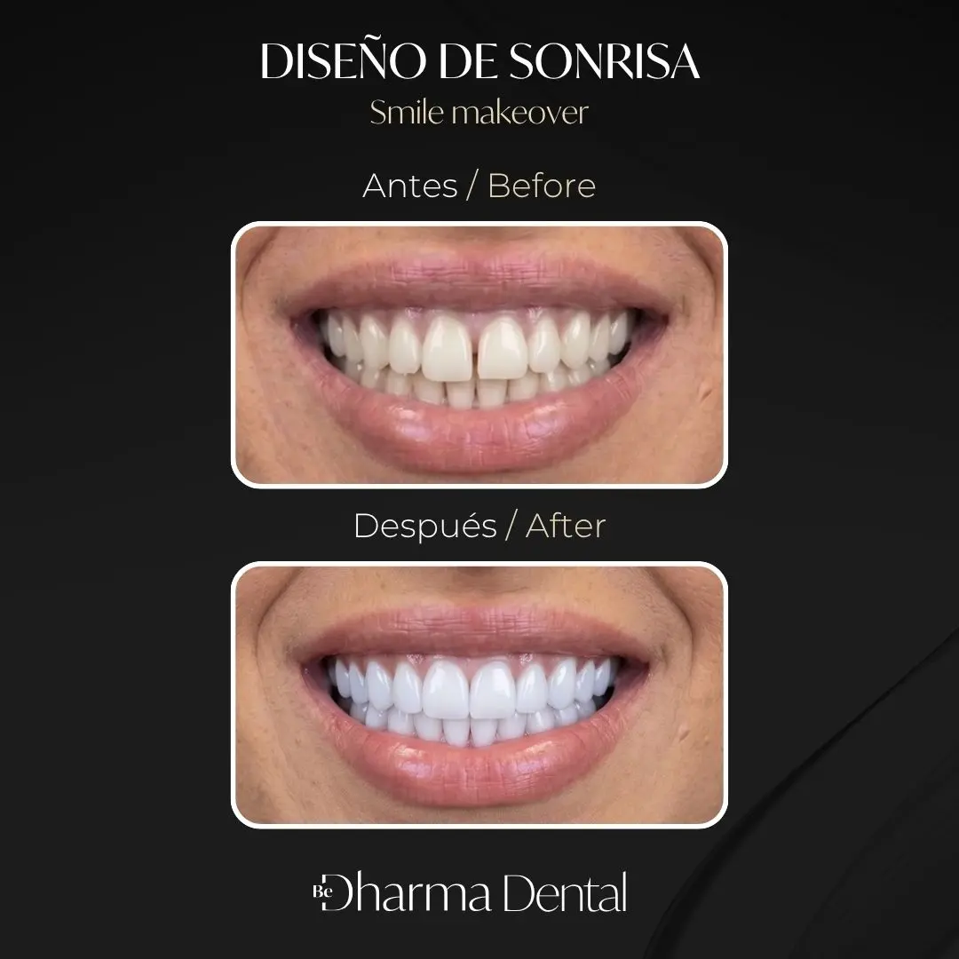 Smile makeover before and after (bilingual case), real patient at Be Dharma Dental Medell&iacute;n