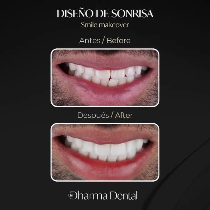 Diseño de sonrisa en cerámica vs resina- Dharma Dental Medellín