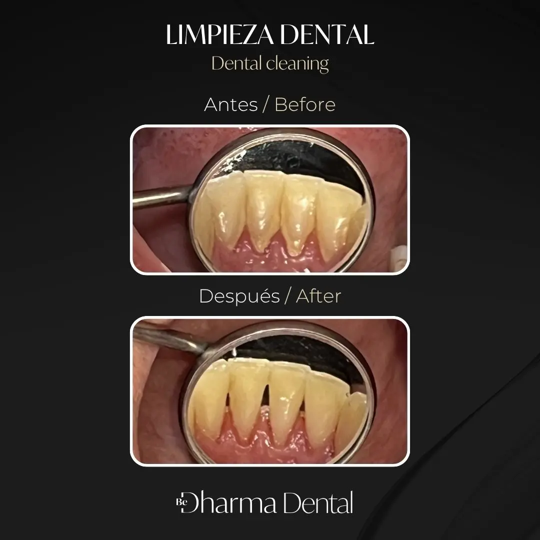 Limpieza dental antes y después en la clínica odontológica Be Dharma Dental - Medellín, Colombia- 050626