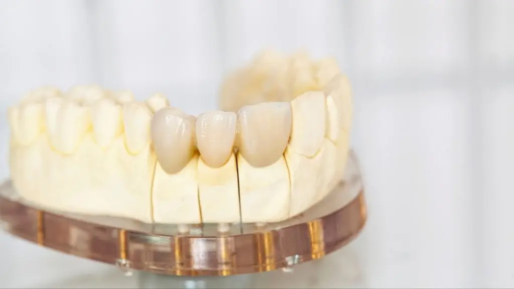 Precio de una corona dental en Colombia - Clinica de odontología estética Be Dharma Dental