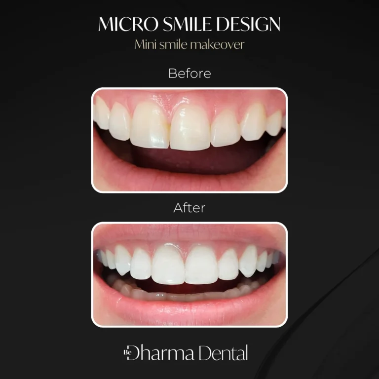 Before and after composite veneers &mdash; micro smile design case at Be Dharma Dental, Medell&iacute;n