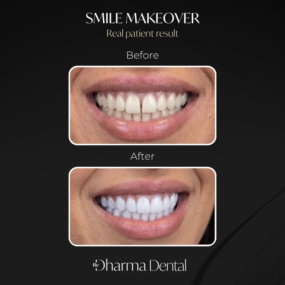 Smile makeover before and after, real patient at Be Dharma Dental Medellín