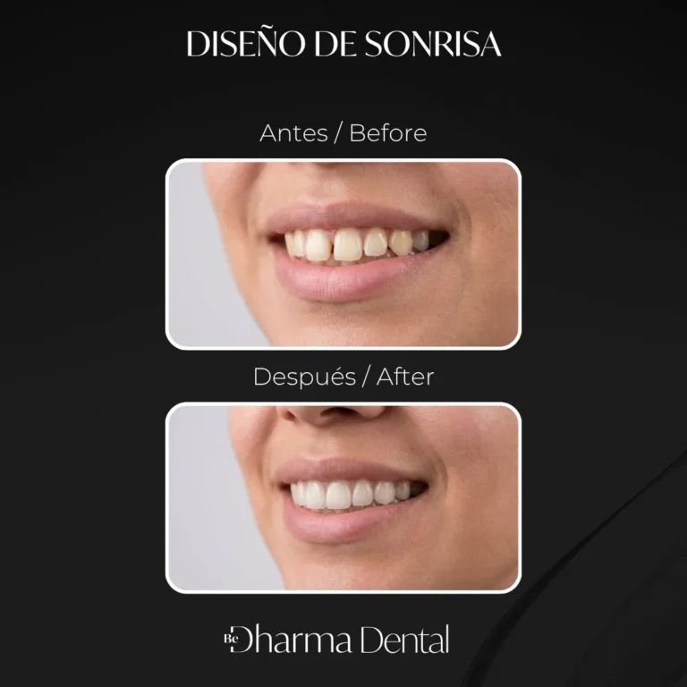 Veneers before and after: female smile &mdash; Be Dharma Dental, Medell&iacute;n