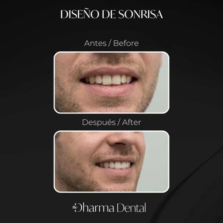Veneers before and after: male smile &mdash; Be Dharma Dental, Medell&iacute;n