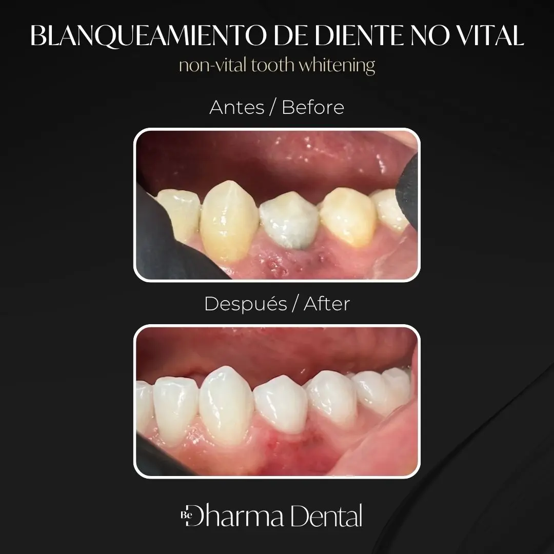 Blanqueamiento dental de diente no vital antes y después en la clínica odontológica Be Dharma Dental - Medellín, Colombia- 080726