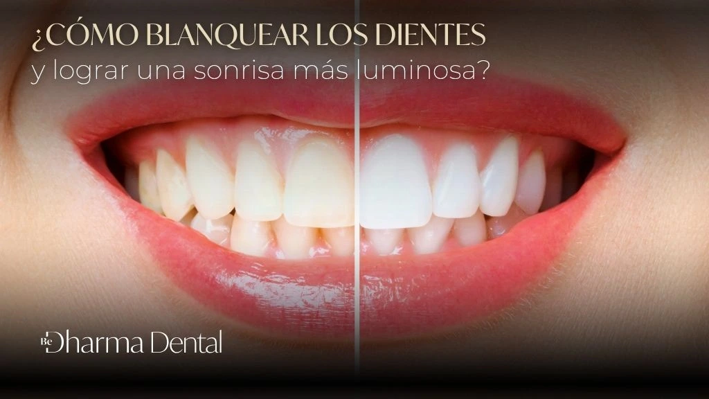Cómo blanquear los dientes y lograr una sonrisa más luminosa - Be Dharma Dental