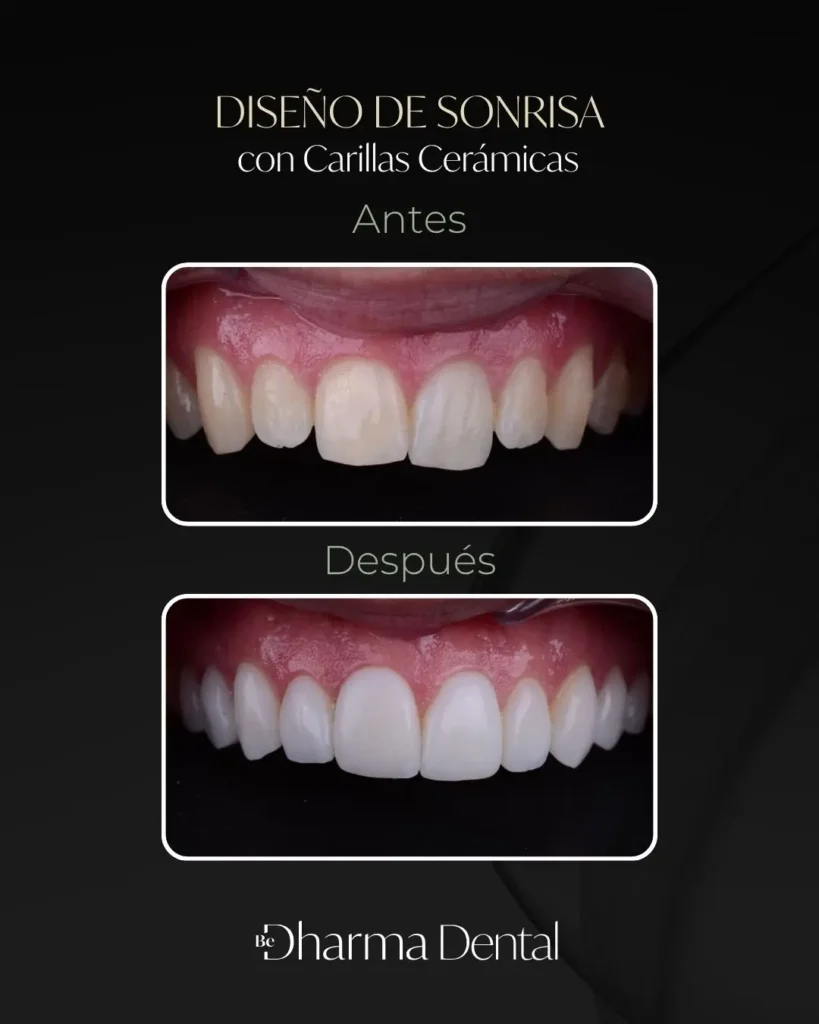Cuánto dura un diseño de sonrisa en cerámica - Antes y Después - Clínica de odontología estética en Medellín, Colombia