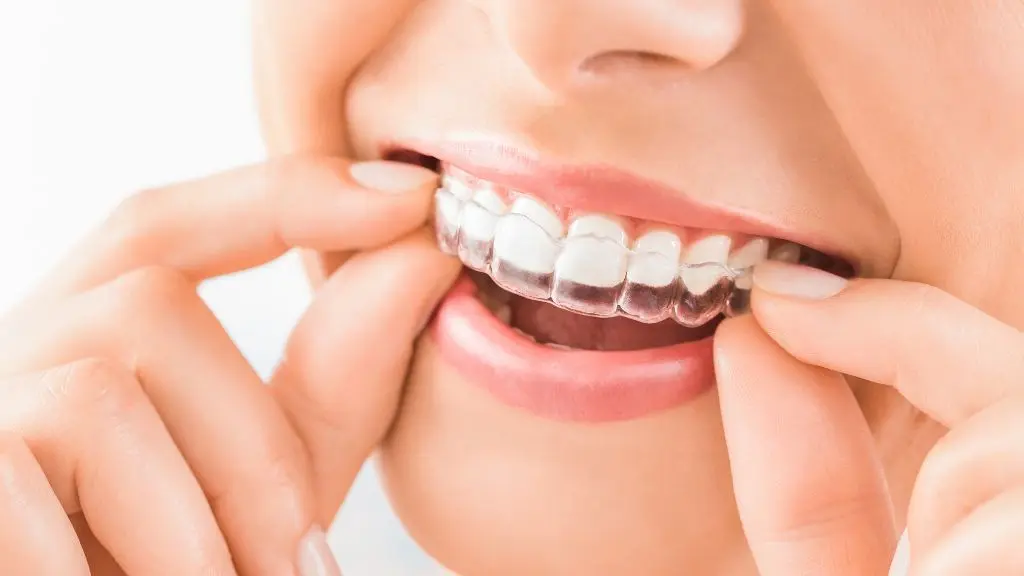 Microdiseño de sonrisa después de ortodoncia en Medellín - Be Dharma Dental