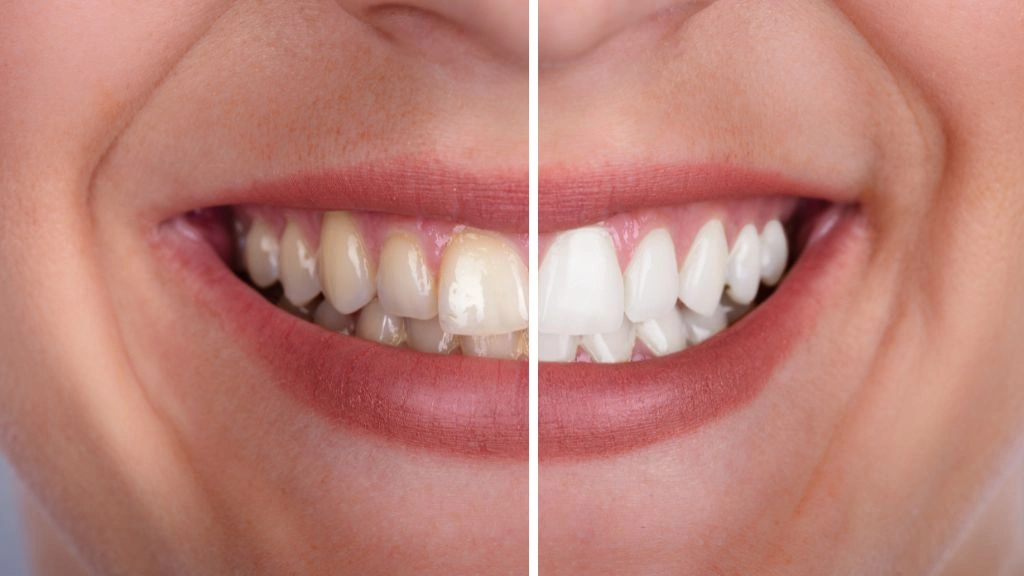 Que hacer para tener los dientes blancos - Considerar un blanqueamiento dental profesiona l- Be Dharma Dental